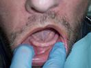 Implants-for-Overdenture-Before-Image