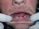 Implants-for-Overdenture-After-Image